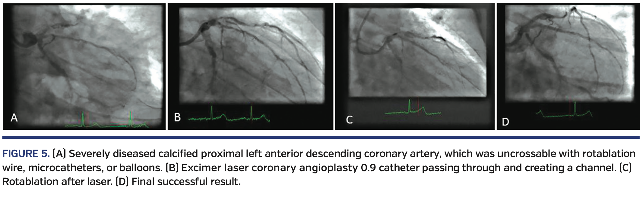 Excimer Laser Coronary Angioplasty (ELCA) Fundamentals, Mechanism of